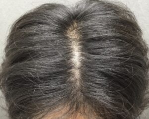 AGA治療前　22歳男性　生え際・頭頂部薄毛　京都院