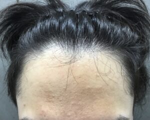 AGA治療前　22歳男性　生え際・頭頂部薄毛　京都院