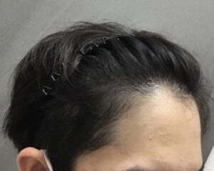 AGA治療3ヶ月後　22歳男性　生え際・頭頂部改善　京都院