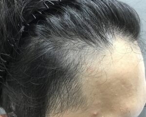 AGA治療前　22歳男性　生え際・頭頂部薄毛　京都院