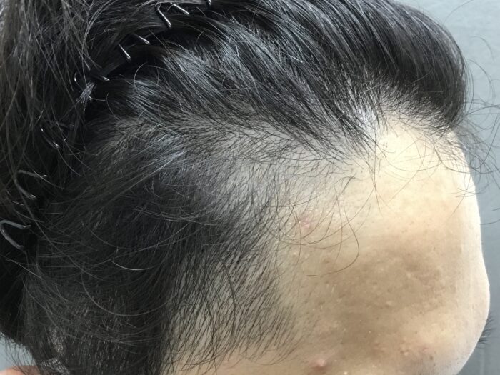 【22歳男性】生え際・頭頂部の薄毛がAGA治療で改善｜京都院