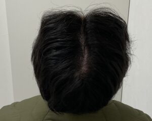 AGA治療12ヵ月後　21歳男性　生え際・頭頂部薄毛改善　岡山院