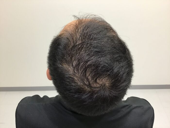 【48歳男性】頭頂と生え際の薄毛がAGA治療で改善｜鹿児島院