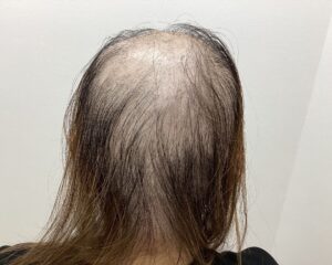 全頭型の円形脱毛症治療前　37歳女性　横浜院