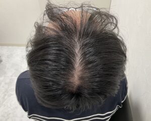 AGA治療前　31歳男性　生え際・頭頂部薄毛　岡山院