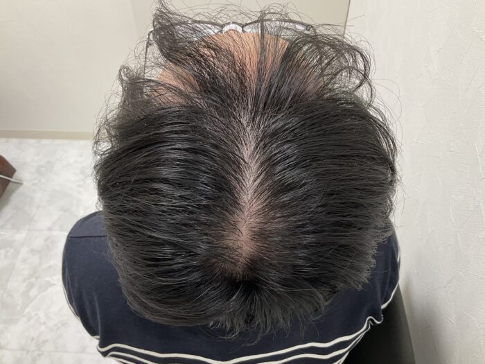 【31歳男性】生え際・頭頂部の薄毛がAGA治療で改善｜岡山院
