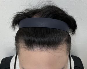 AGA治療前　21歳男性　生え際・頭頂部薄毛　岡山院