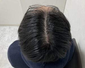 AGA治療8ヵ月後　31歳男性　生え際・頭頂部薄毛改善　岡山院