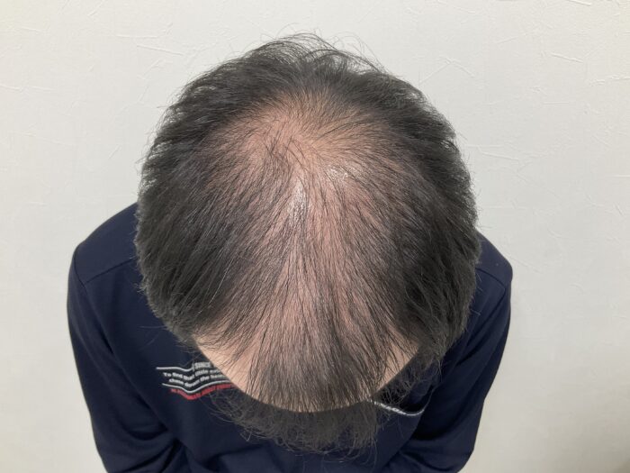 【38歳男性】生え際・頭頂部の薄毛がAGA治療で改善｜岡山院