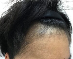 AGA治療後＿23歳男性＿生え際の改善＿大阪梅田院
