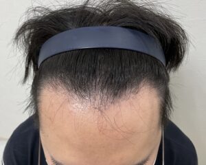 AGA治療前　31歳男性　生え際・頭頂部薄毛　岡山院