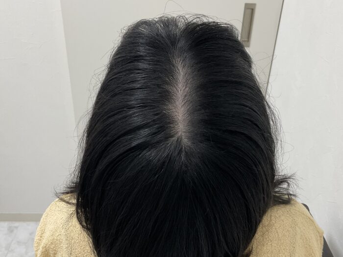 FAGA治療7ヵ月後　22歳女性　分け目の薄毛改善　岡山院