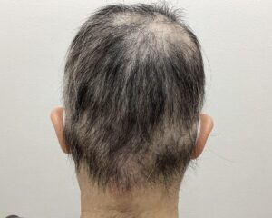 全頭型の円形脱毛症治療3ヵ月目　37歳女性　横浜院