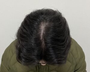 AGA治療12ヵ月後　21歳男性　生え際・頭頂部薄毛改善　岡山院