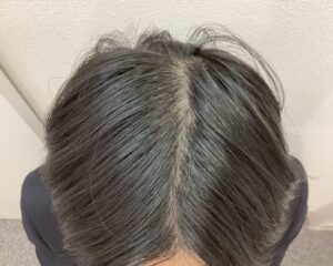 AGA治療前　23歳男性　生え際・頭頂部薄毛　新潟院