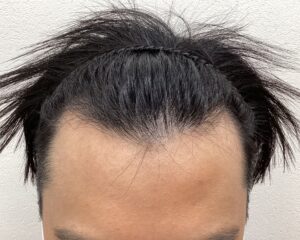 AGA治療前　28歳男性　生え際薄毛　横浜院