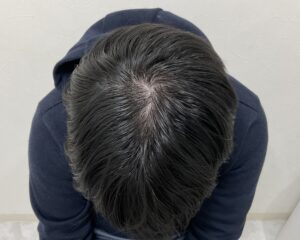 AGA治療8ヵ月後　31歳男性　生え際・頭頂部薄毛改善　岡山院