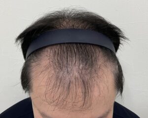 AGA治療前　38歳男性　生え際・頭頂部薄毛　岡山院