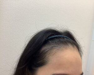 AGA治療前　29歳女性　生え際・頭頂部薄毛　新潟院