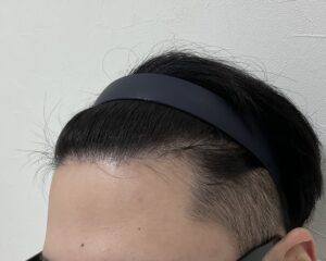AGA治療前　21歳男性　生え際・頭頂部薄毛　岡山院