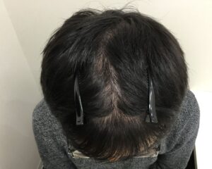AGA治療前＿35歳男性＿生え際・頭頂部の薄毛＿大阪梅田院