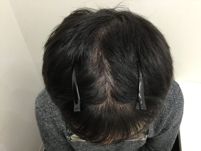 【35歳男性】生え際・頭頂部の薄毛がAGA治療で改善｜大阪梅田院