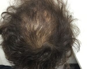 AGA治療前＿38歳男性＿生え際・頭頂部の薄毛＿大阪梅田院