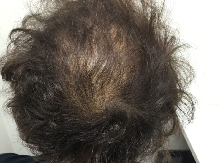 【38歳男性】生え際・頭頂部の薄毛がAGA治療で改善｜大阪梅田院