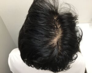 AGA治療前＿33歳男性＿生え際・頭頂部の薄毛＿大阪梅田院