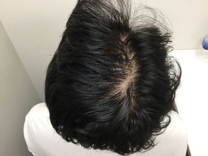 【33歳男性】生え際・頭頂部の薄毛がAGA治療で改善｜大阪梅田院