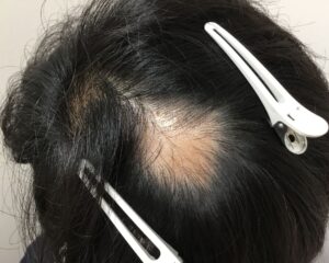 円形脱毛症治療前＿23歳男性＿頭頂部の円形脱毛症＿大阪梅田院