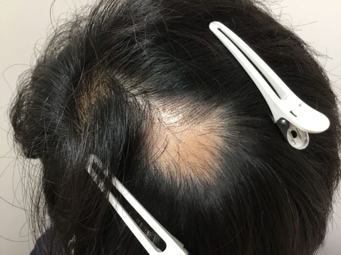 【23歳男性】生え際のAGA＋円形脱毛症がメソセラピー治療で改善｜大阪梅田院