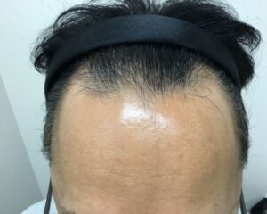 AGA治療前_47歳男性_生え際・頭頂部の薄毛_大阪梅田院