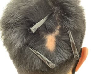 円形脱毛症治療前＿32歳男性＿単発型の円形脱毛症＿大阪梅田院