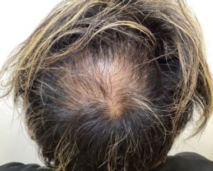 AGA治療前_44歳男性_生え際・頭頂部の薄毛_広島院