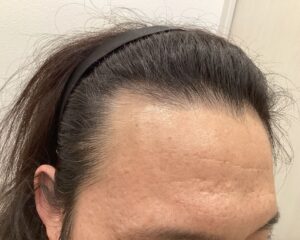 AGA治療前＿44歳男性＿生え際・頭頂部の薄毛＿大阪梅田院
