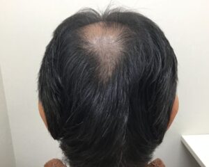 AGA治療前_54歳男性_生え際・頭頂部の薄毛_大阪梅田院