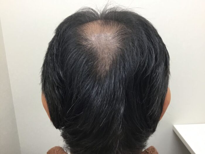 【54歳男性】生え際・頭頂部の薄毛がAGA治療で改善｜大阪梅田院