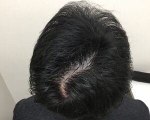 AGA治療前_38歳男性_生え際・頭頂部の薄毛_大阪梅田院