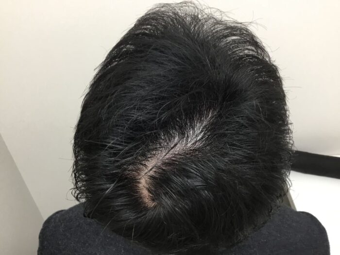 【38歳男性】生え際・頭頂部の薄毛がAGA治療で改善｜大阪梅田院