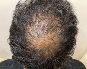 AGA治療前＿56歳男性＿生え際・頭頂部の薄毛＿広島院