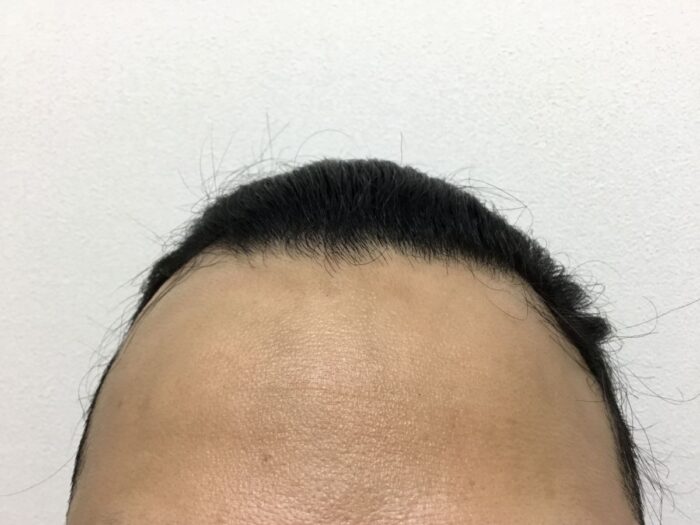 【34歳男性】生え際・頭頂部の薄毛がAGA治療で改善｜大阪梅田院