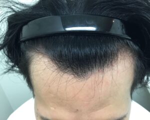 AGA治療前＿29歳男性＿生え際・頭頂部の薄毛＿大阪梅田院