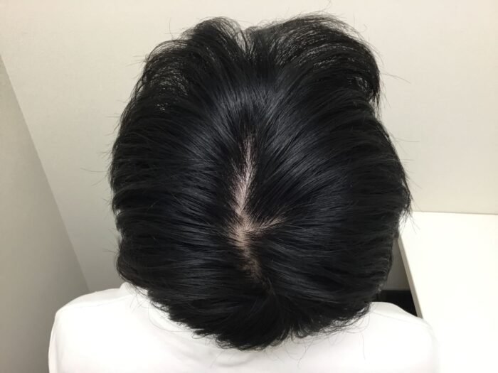 AGA治療前＿25歳男性＿生え際・頭頂部の薄毛＿大阪梅田院