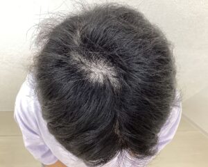 全頭型の円形脱毛症治療7ヵ月目　37歳女性　横浜院