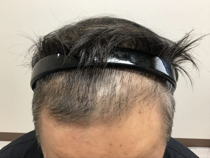 AGA治療3ヶ月後　43歳男性　生え際・前頭部改善　鹿児島院