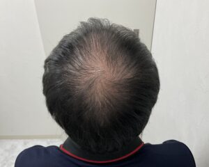 AGA治療前　38歳男性　頭頂部薄毛　岡山院