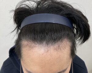 AGA治療8ヵ月後　31歳男性　生え際・頭頂部薄毛改善　岡山院