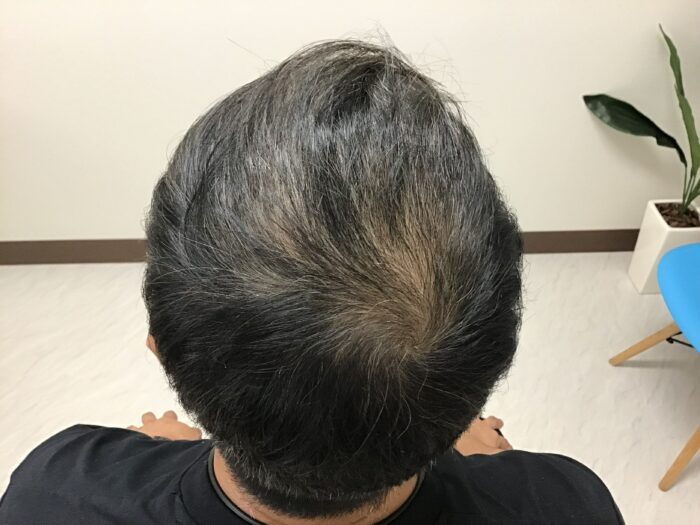AGA治療3ヶ月後　43歳男性　頭頂部改善　鹿児島院