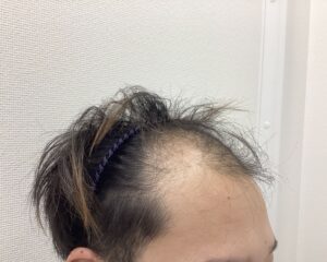 AGA治療前　32歳男性　前頭・頭頂部薄毛　新潟院